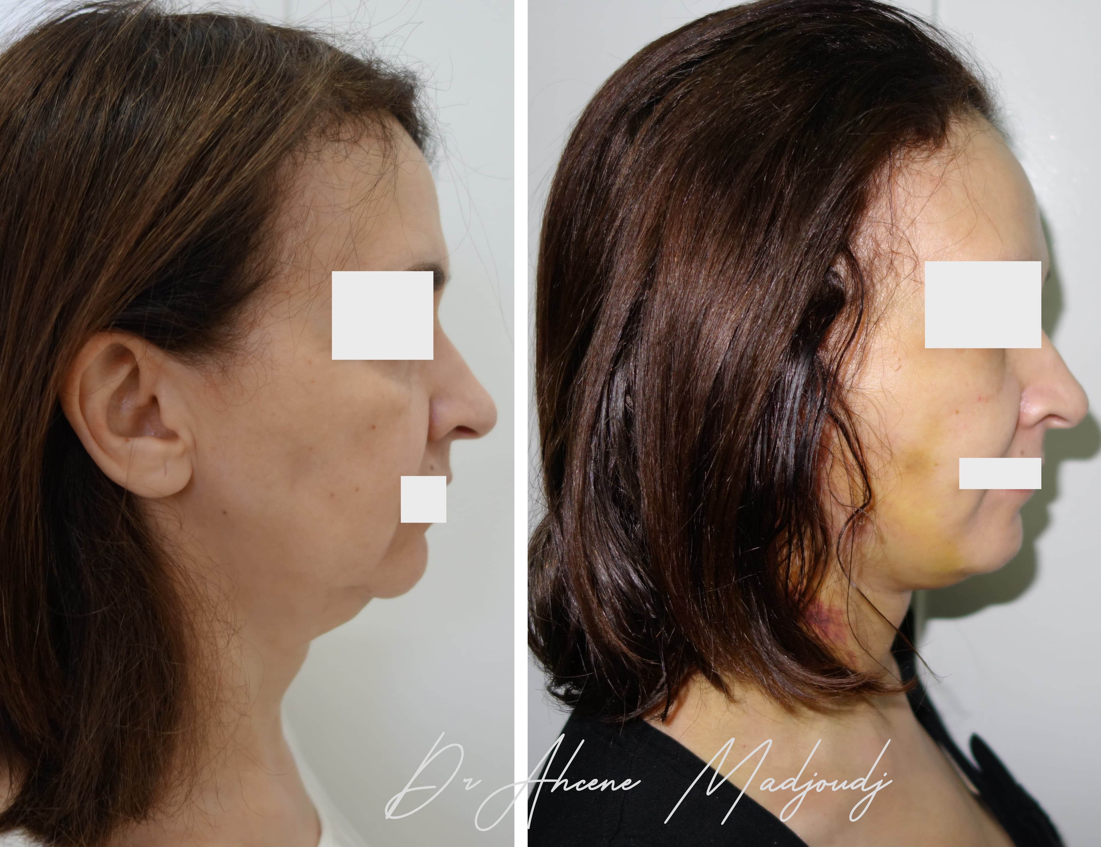 Lifting du Visage en algérie 6 mois après