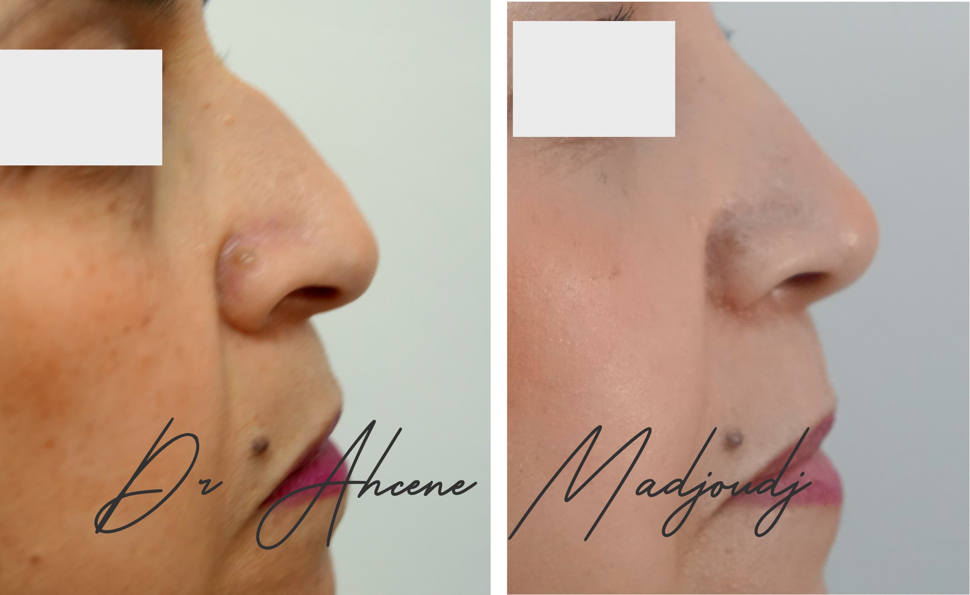 rhinoplastie en Alger, Algerie  par le Dr Ahcène Madjoudj 