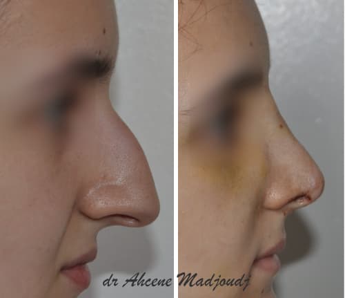 rhinoplastie en algerie par le docteur Madjoudj Ahcene