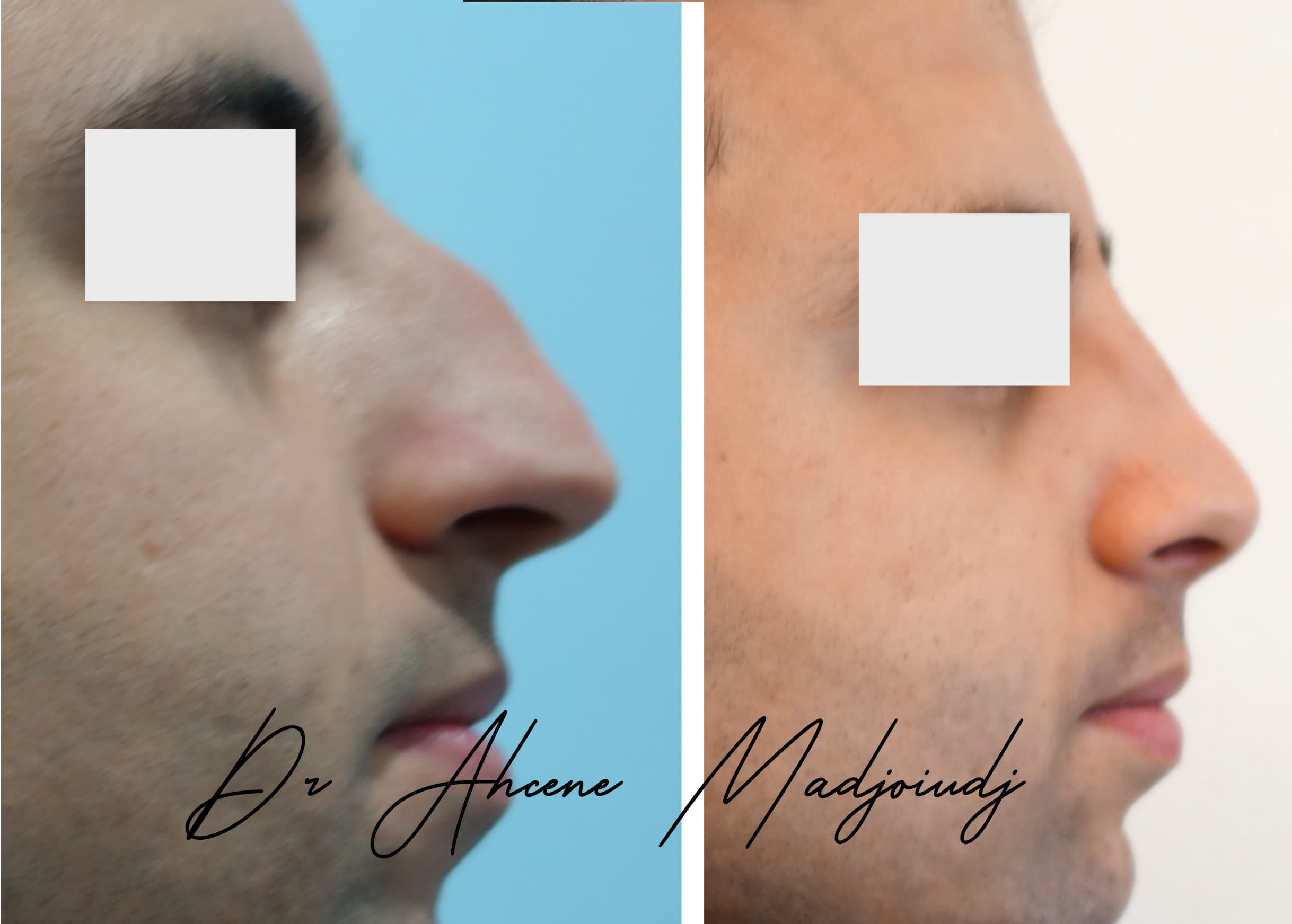 rhinoplastie homme en Algerie  par le Dr Ahcène Madjoudj 