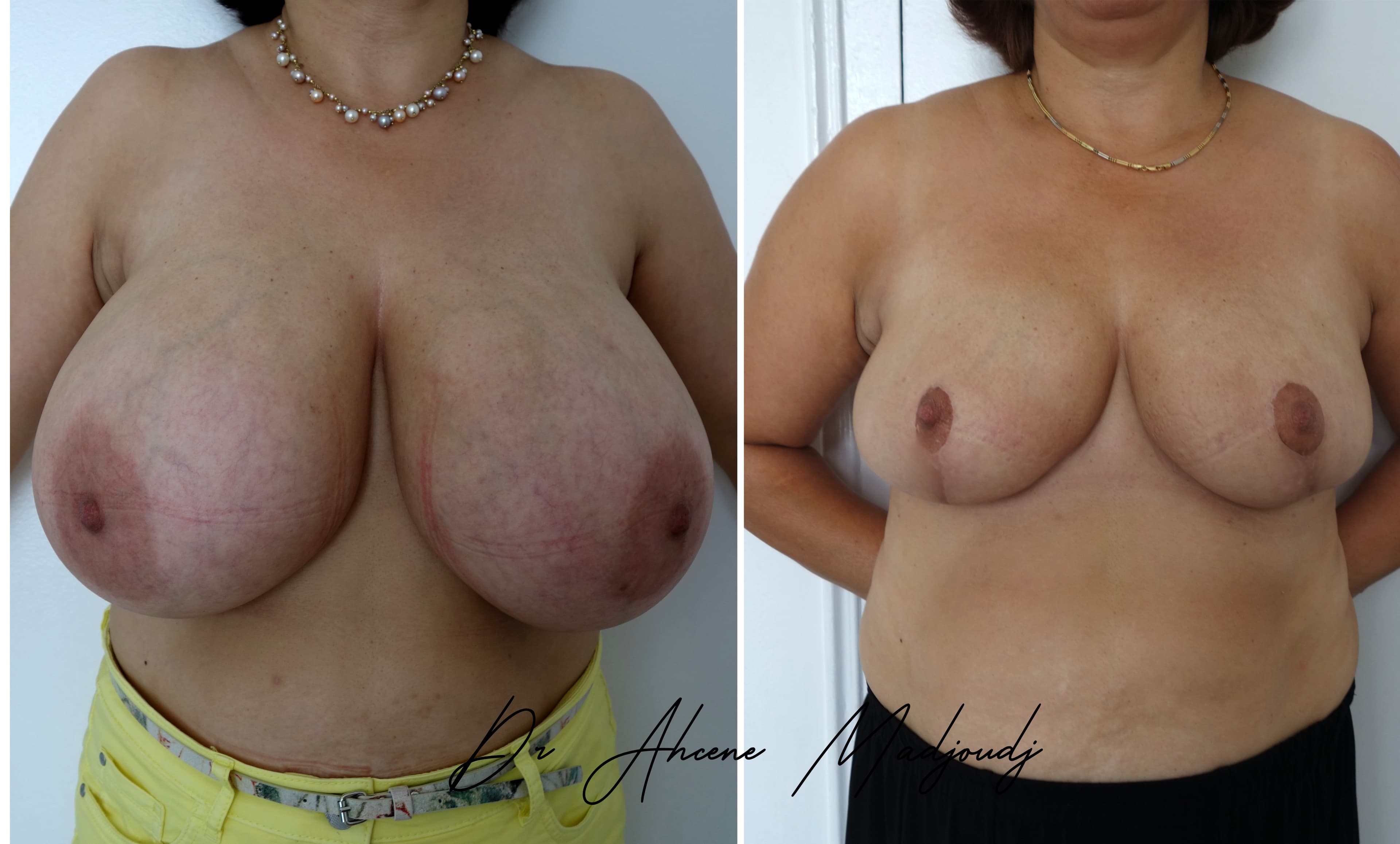 Réduction Mammaire en Algerie par  Le Docteur Madjoudj