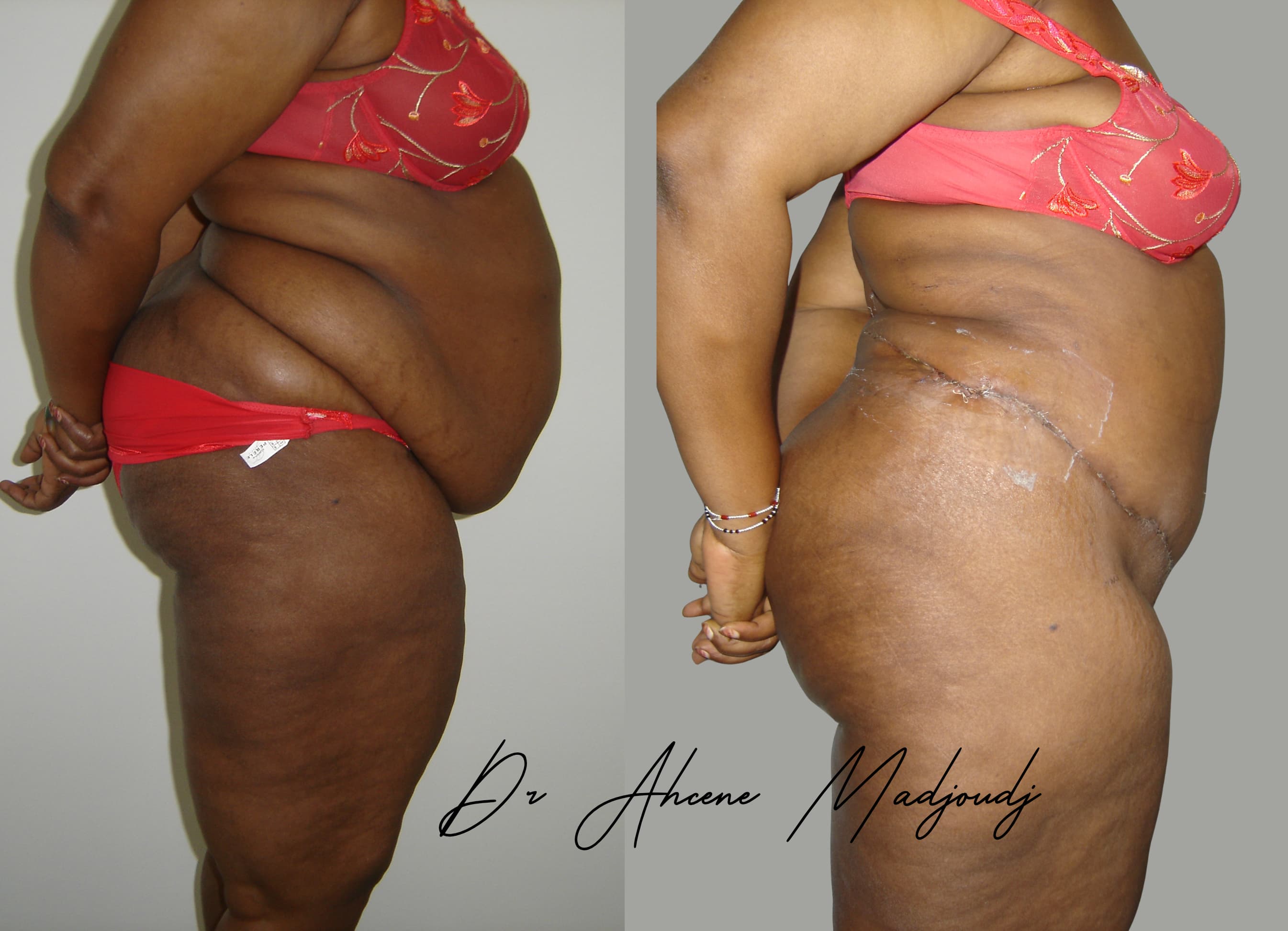 Abdominoplastie à Alger , Algérie par le dr Madjoudj