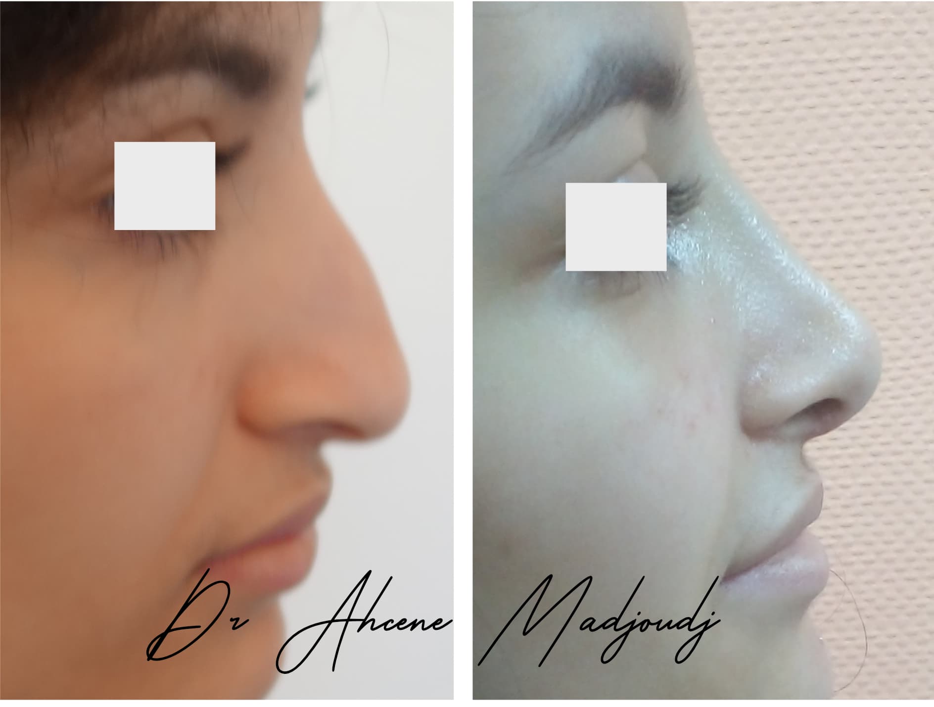 rhinoplastie en Algerie  par le Dr Ahcène Madjoudj 