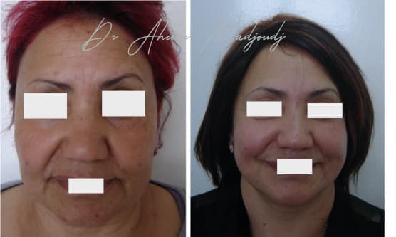 Lifting du Visage en algérie 9 mois aprèss