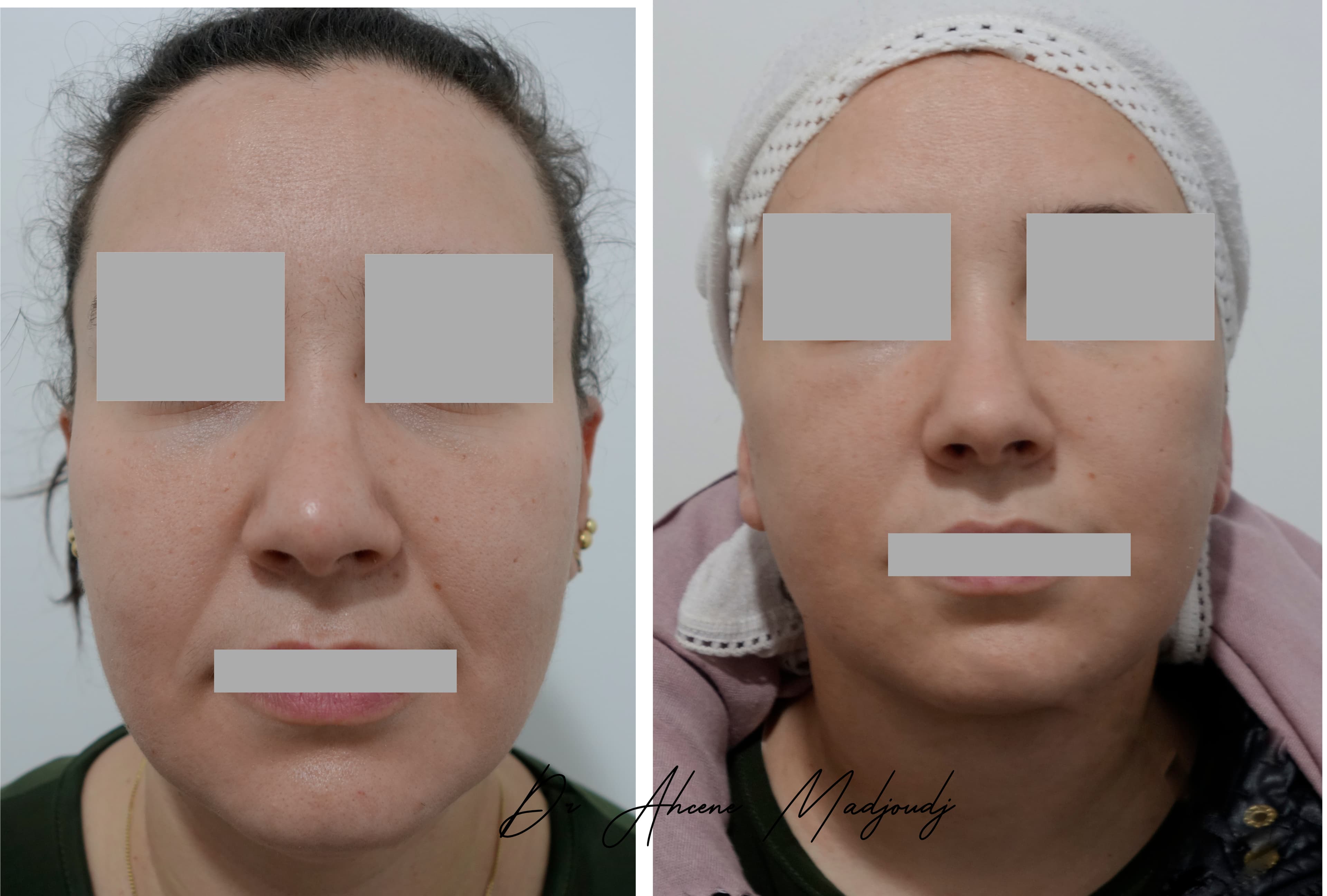 Lifting du Visage en algérie 9 mois après