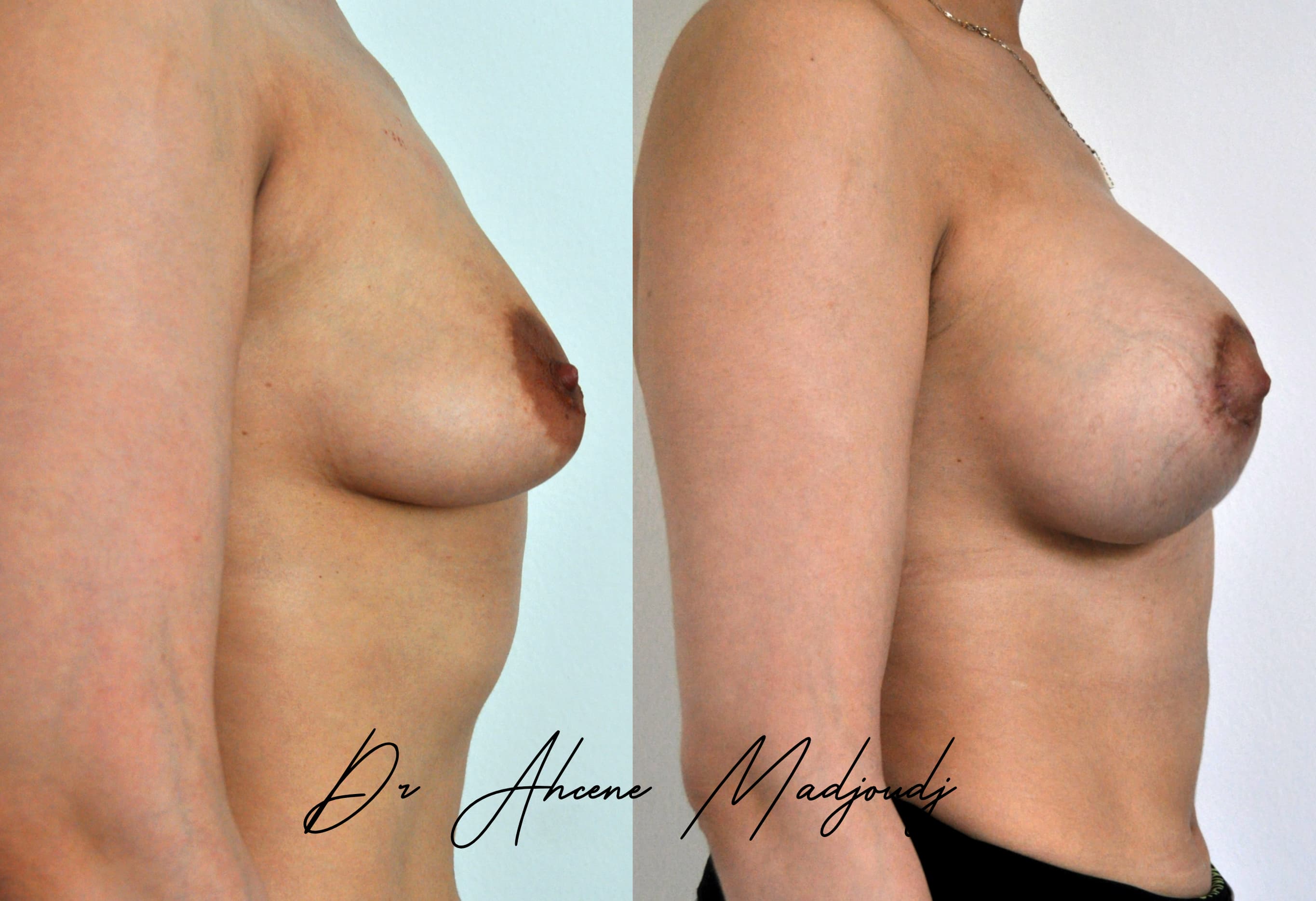 Augmentation Mammaire avec Implants à Alger , algerie par le docteur Madjoudj