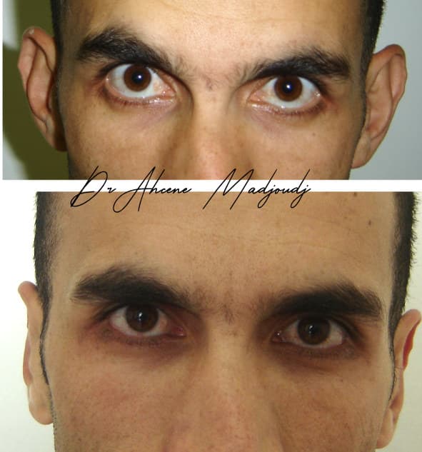 Otoplastie à Alger, Algerie par le Dr Madjoudj 