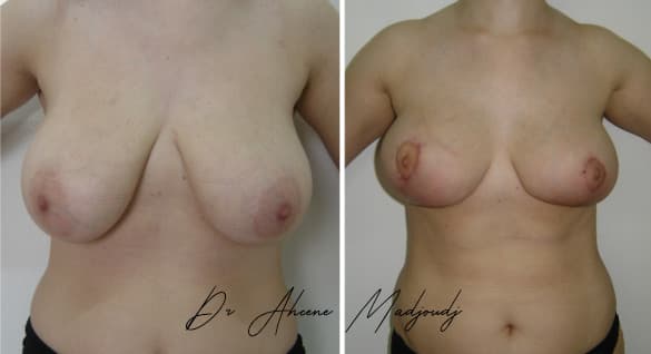 Lift Mammaire en Algérie