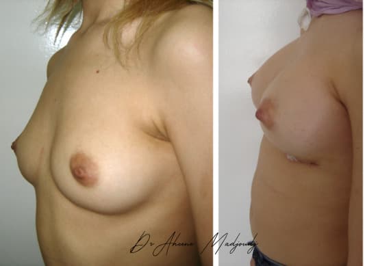 Augmentation Mammaire avec Implants à Alger , algerie par le docteur Madjoudj