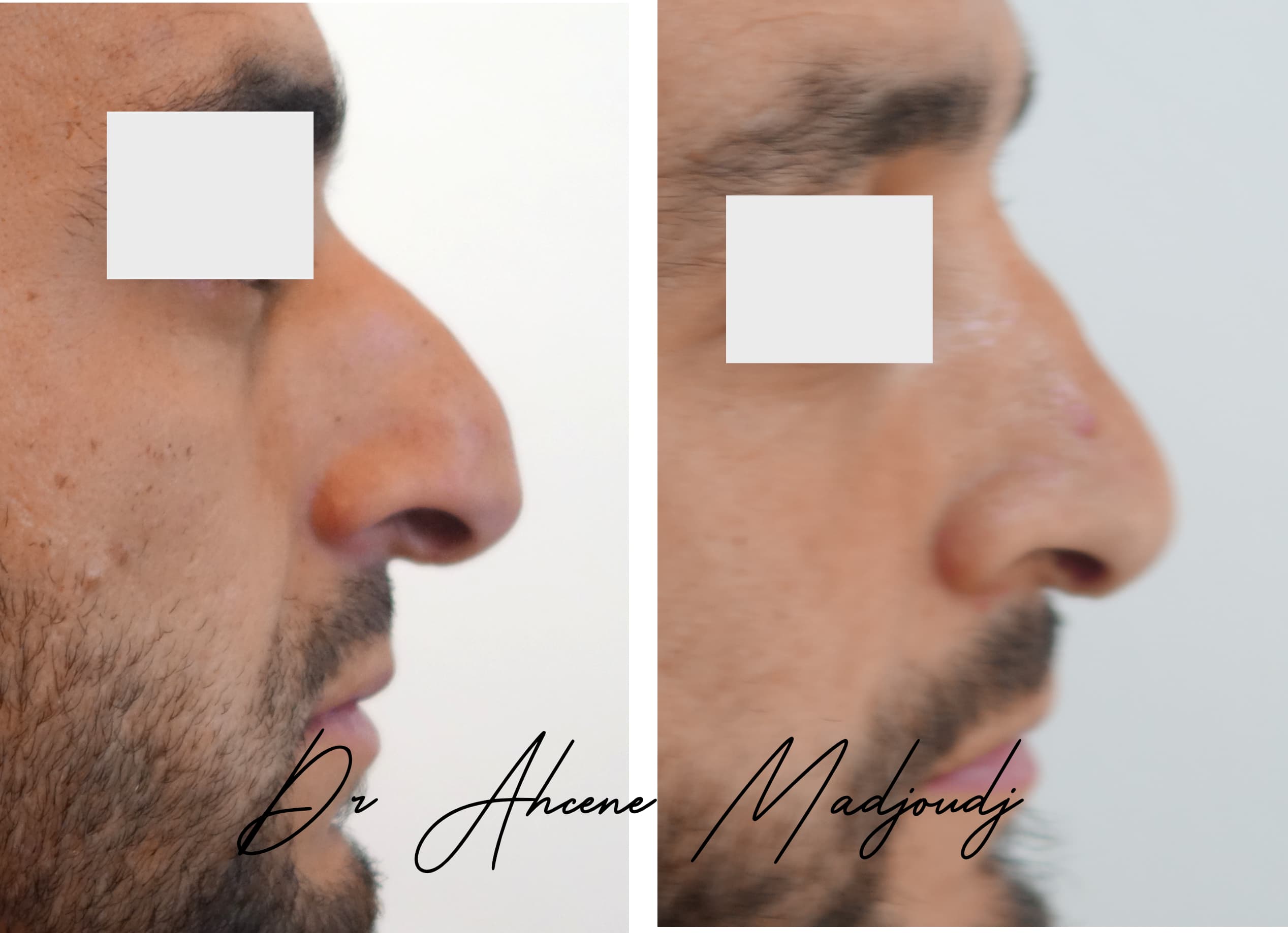 rhinoplastie homme en Algerie  par le Dr Ahcène Madjoudj 