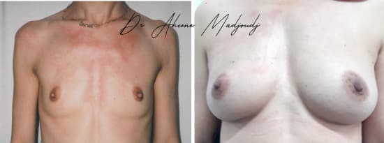 Lipofilling des Seins à Alger,Algerie | Dr Madjoudj |