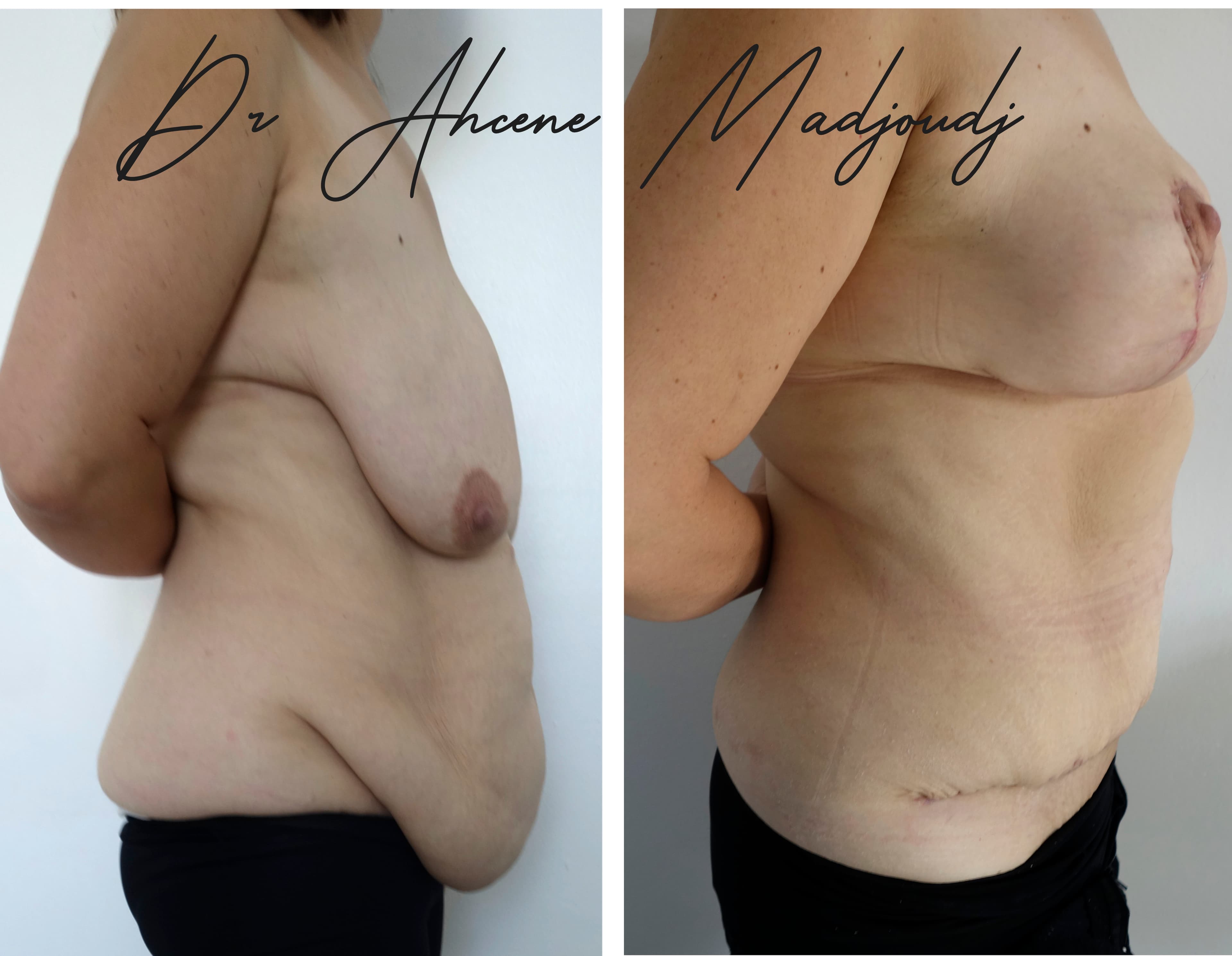 Chirurgie Post-Grossesse ou Mommy Makeover à Algerie