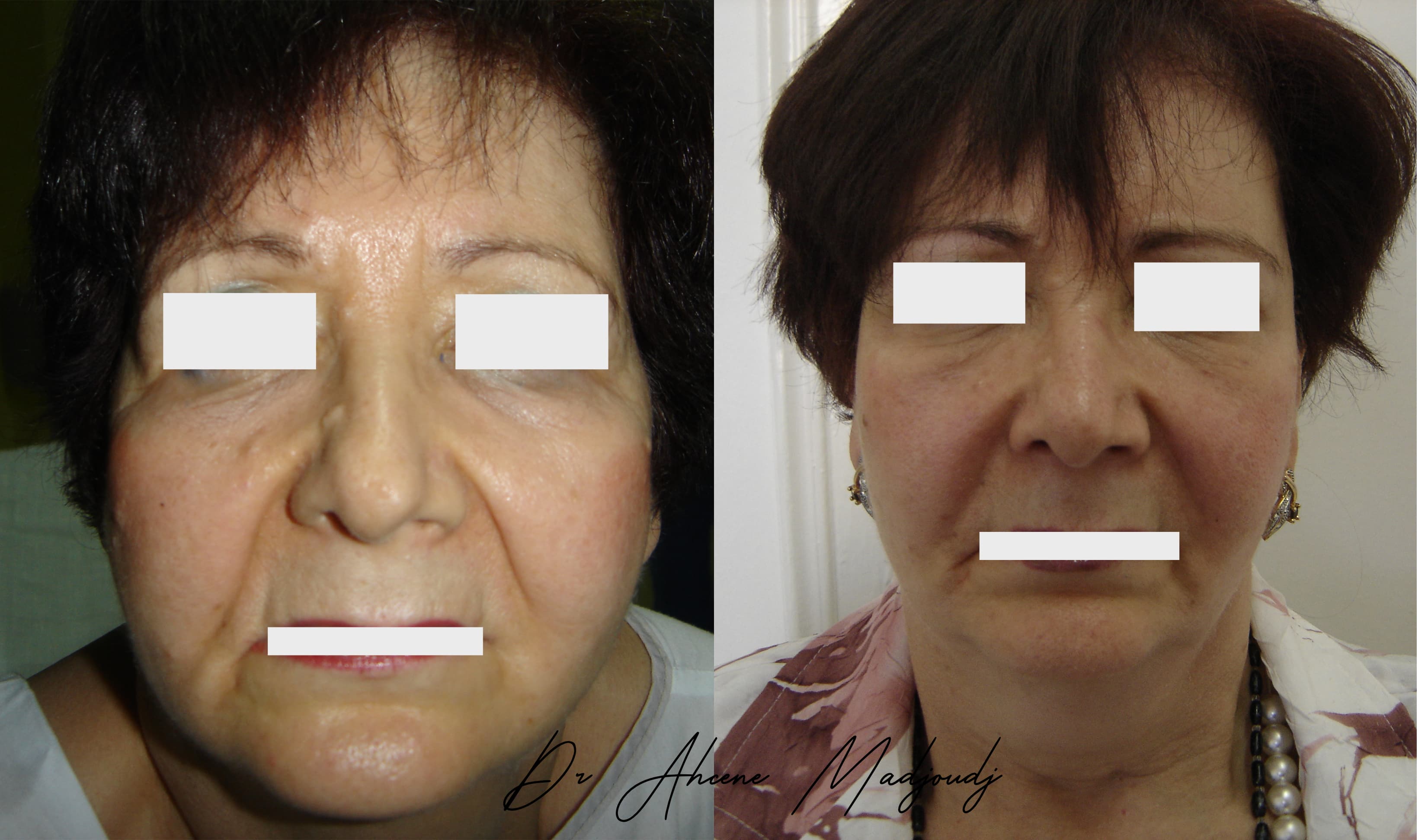 Lifting du Visage en algérie 1 an après