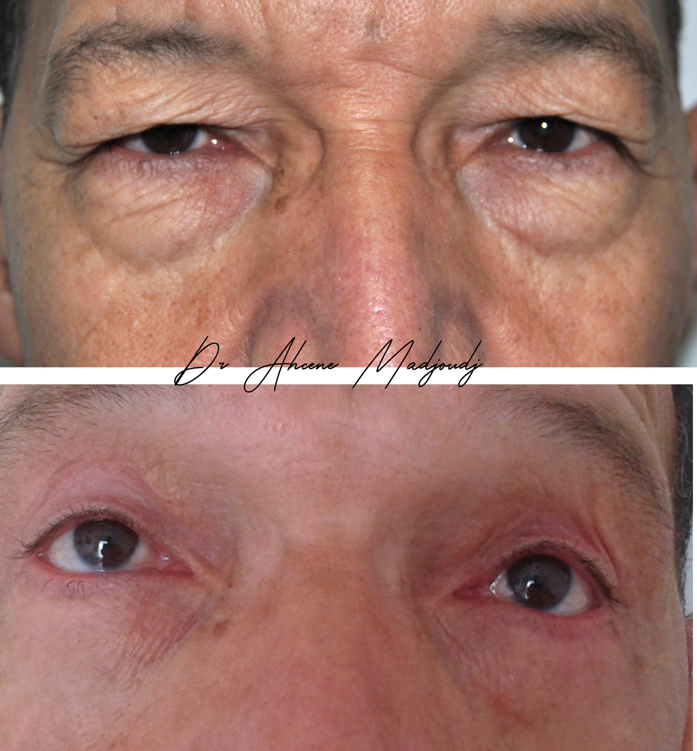 Blépharoplastie à Alger par le Dr Madjoudj |