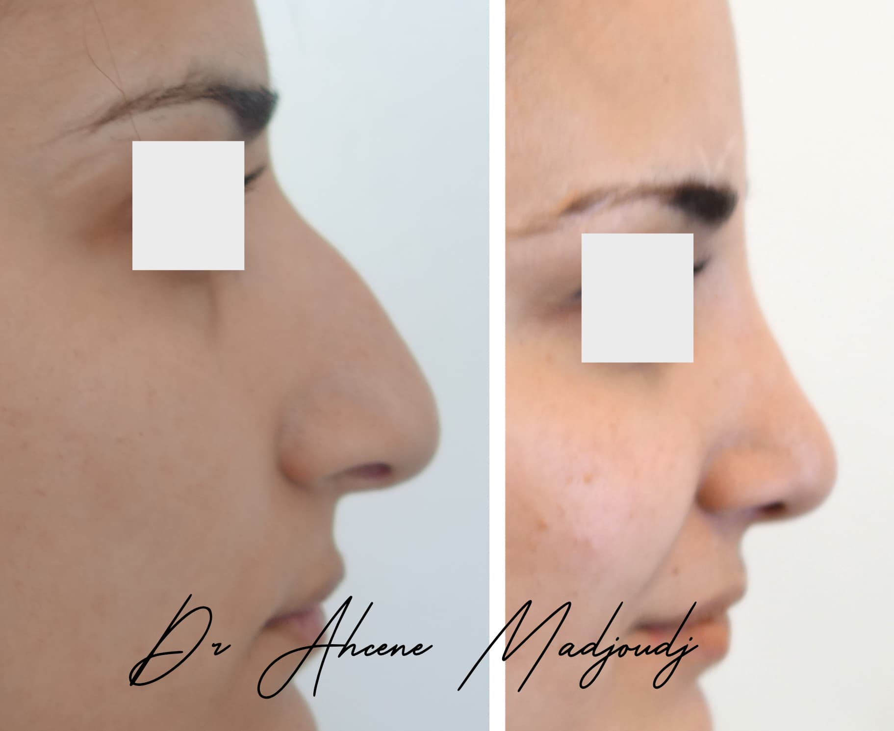rhinoplastie en Algerie  par le Dr Ahcène Madjoudj 