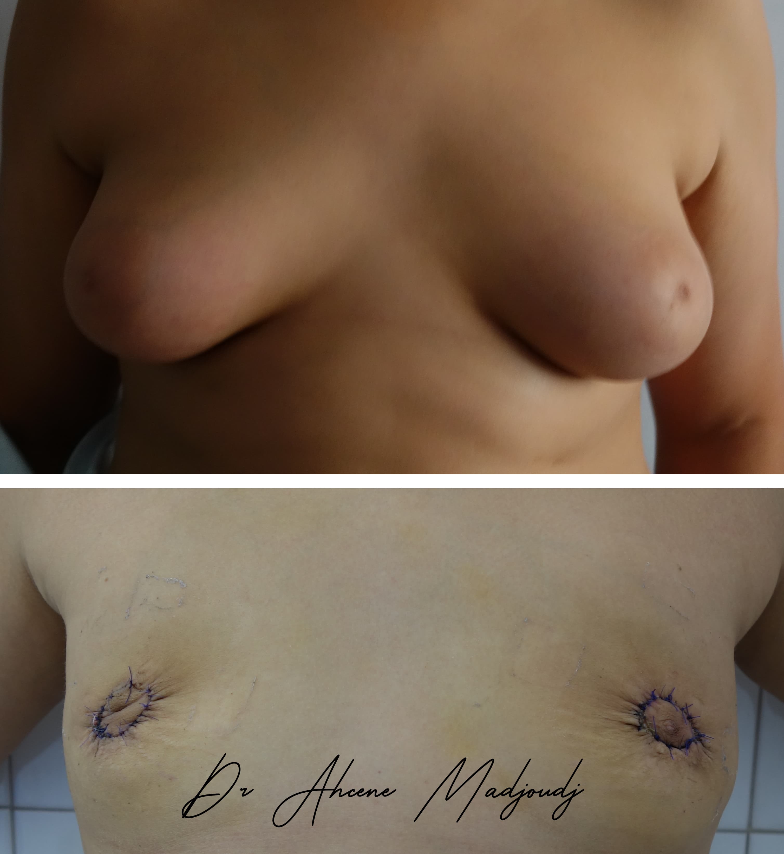 Traitement de la Gynécomastie sévère en Algérie