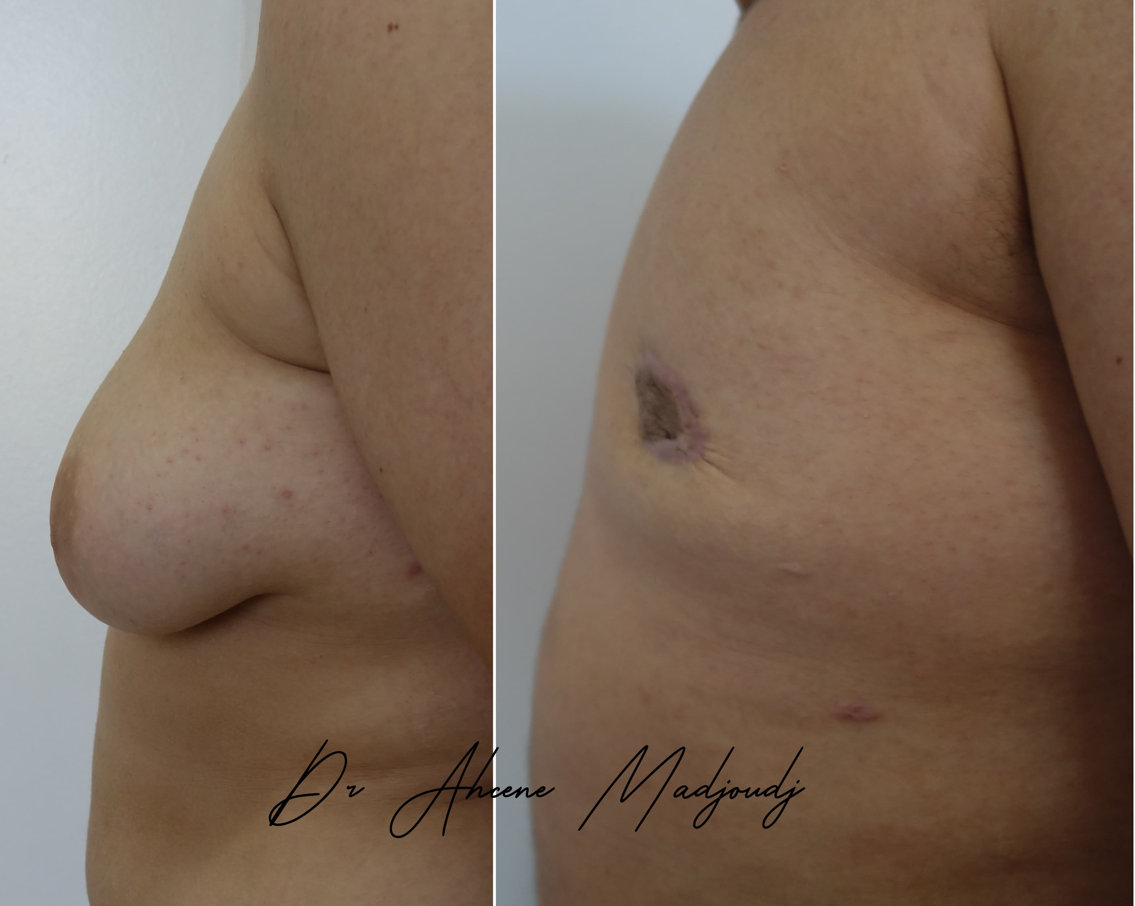 Traitement de la Gynécomastie sévère en Algérie