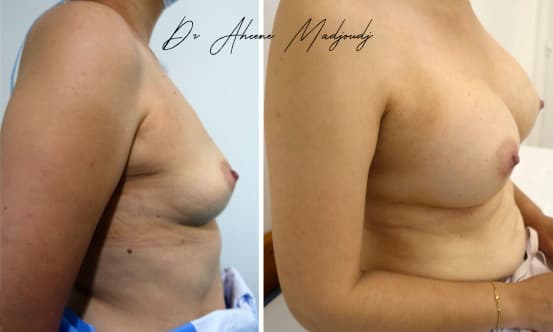 Augmentation Mammaire avec Implants à Alger , algerie par le docteur Madjoudj