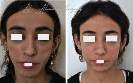 Lipofilling syndrome Parry-Romberg  ]à Alger, Algérie