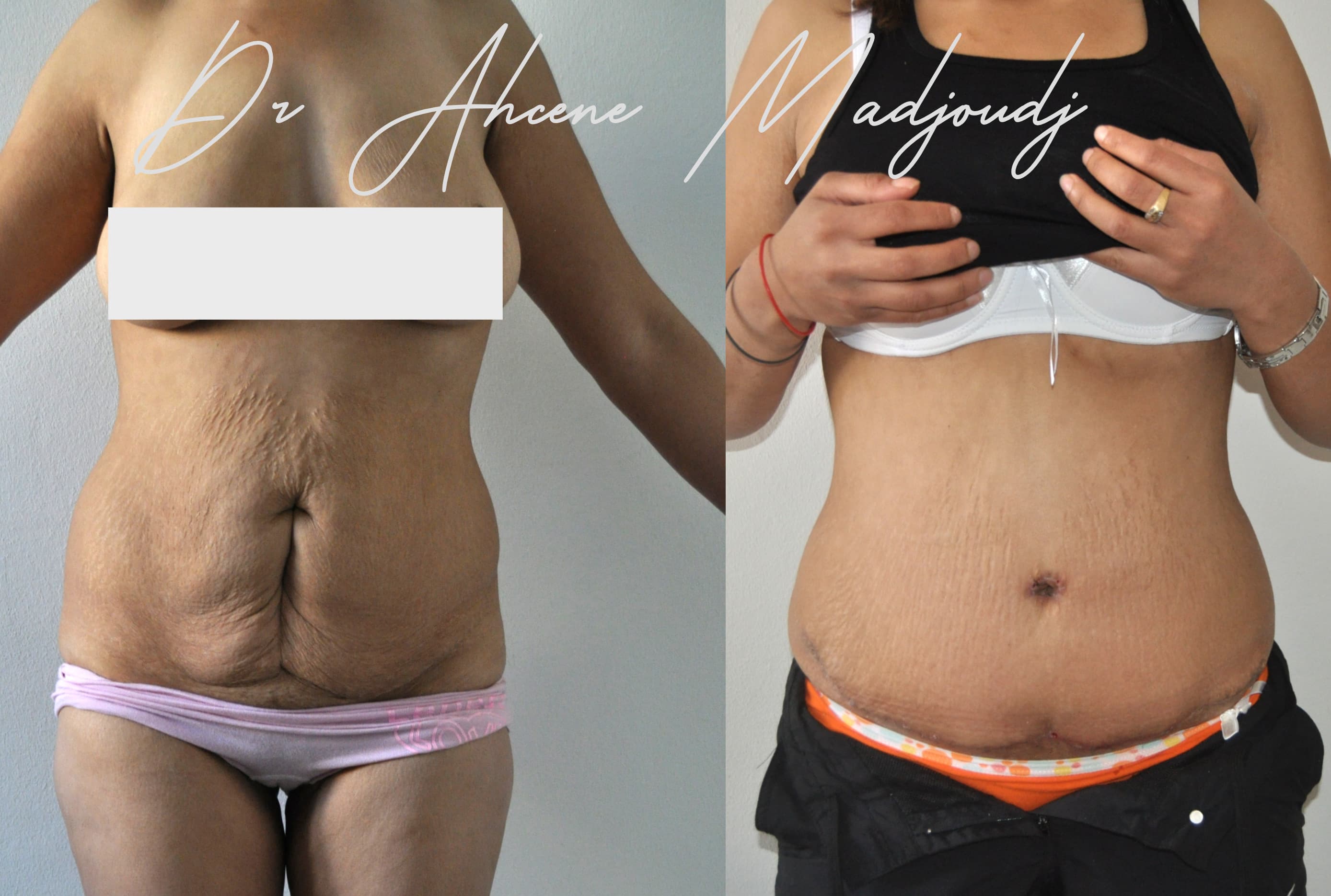 Liposuccion & Liposculpture à Alger par Le docteur Madjoudj