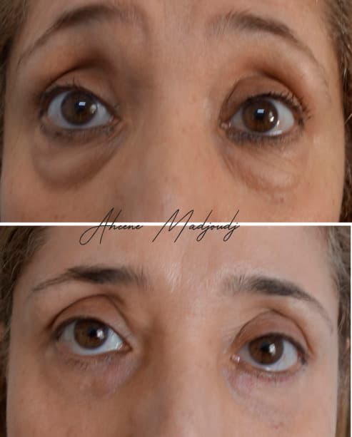 blepharoplastie-femme-web.jpg