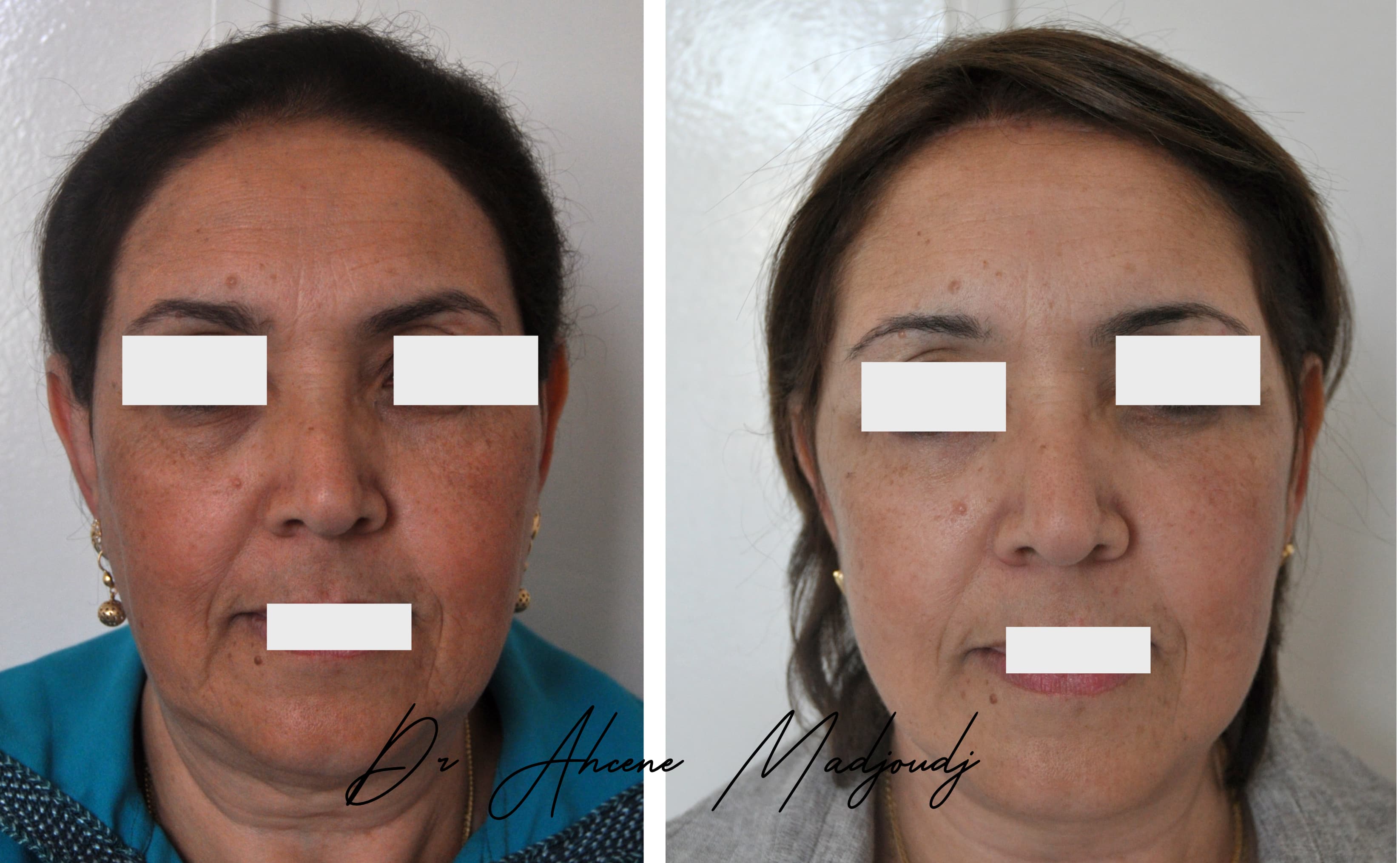 Lifting du Visage en algérie 1 an après