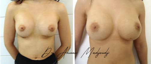 Augmentation Mammaire avec Implants à Alger , algerie par le docteur Madjoudj