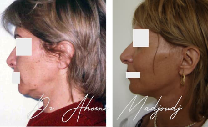 Lifting du Visage en algérie 1 an après