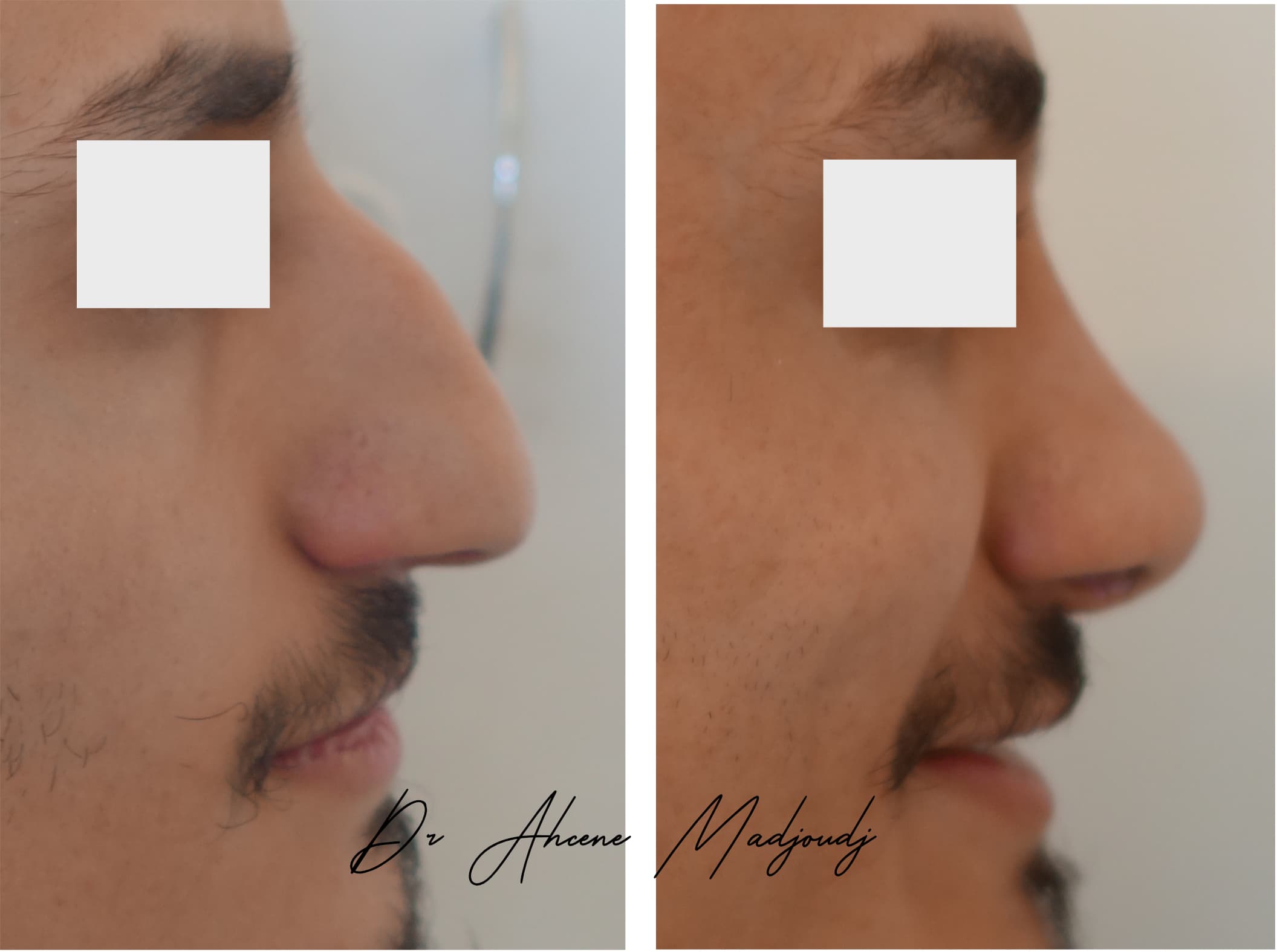 rhinoplastie homme en Algerie  par le Dr Ahcène Madjoudj 