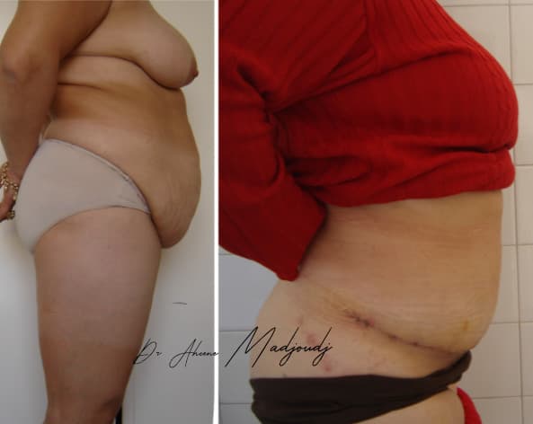 La Réparation du Diastasis : La Fondation d'un Ventre Plat - abdominoplastie par Dr Madjoudj à Alger