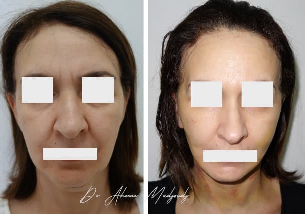 Lifting du Visage à Alger par le Dr Madjoudj