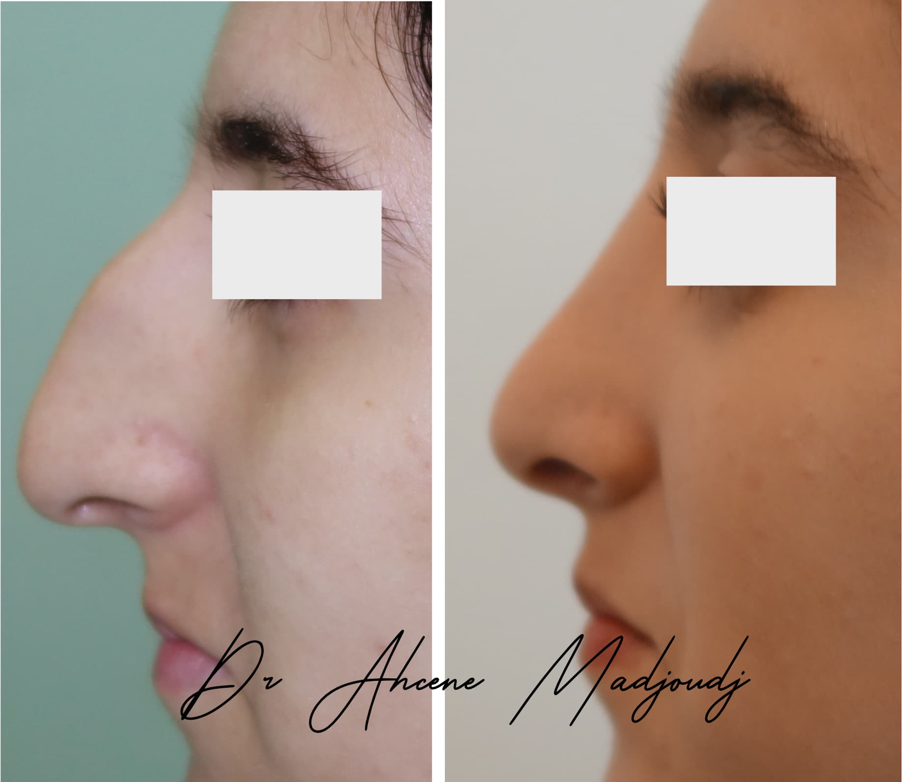 rhinoplastie en Algerie  par le Dr Ahcène Madjoudj 