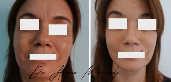 Lipofilling du Visage à Alger, Algerie