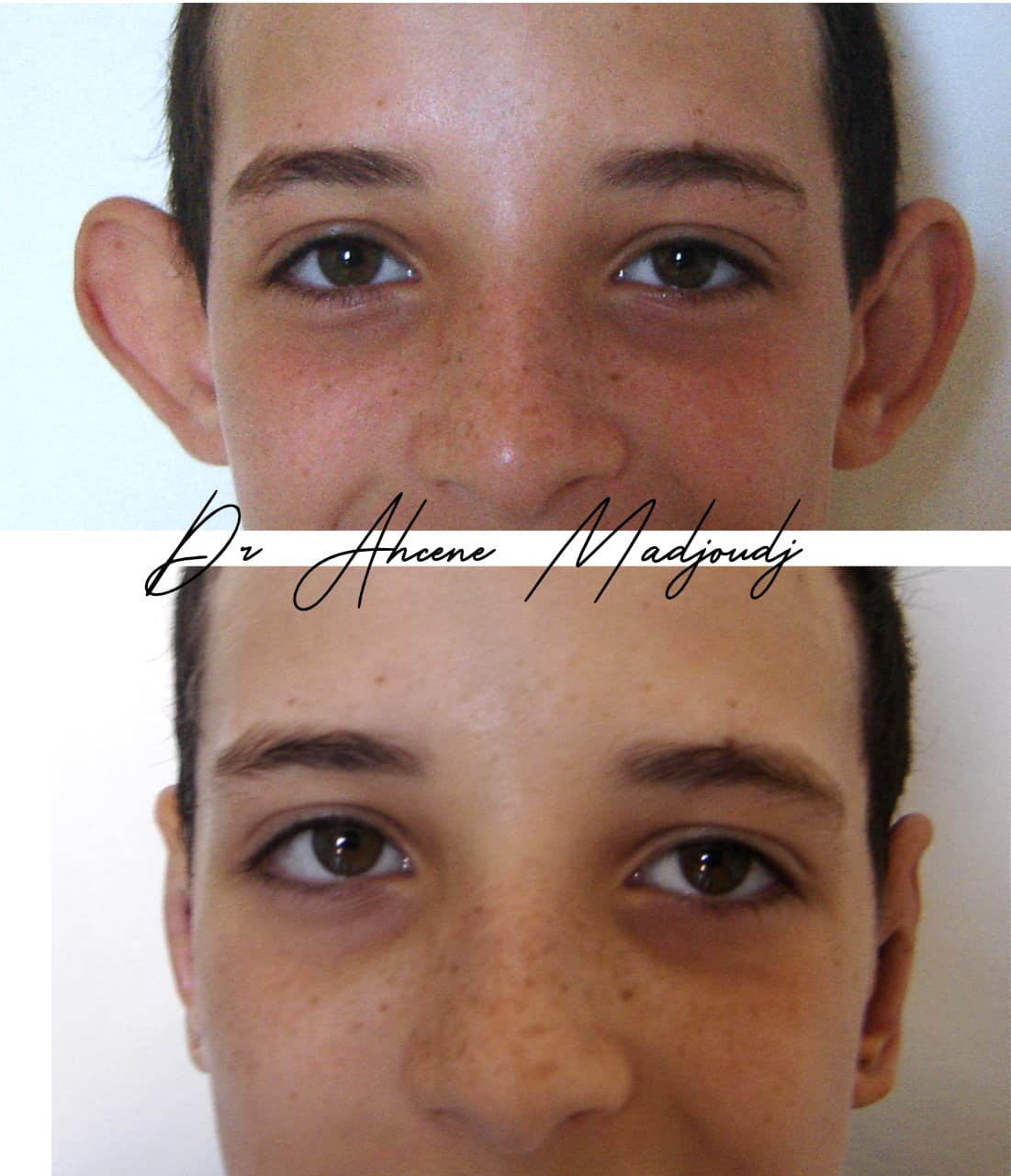 Otoplastie à Alger, Algerie par le Dr Madjoudj 