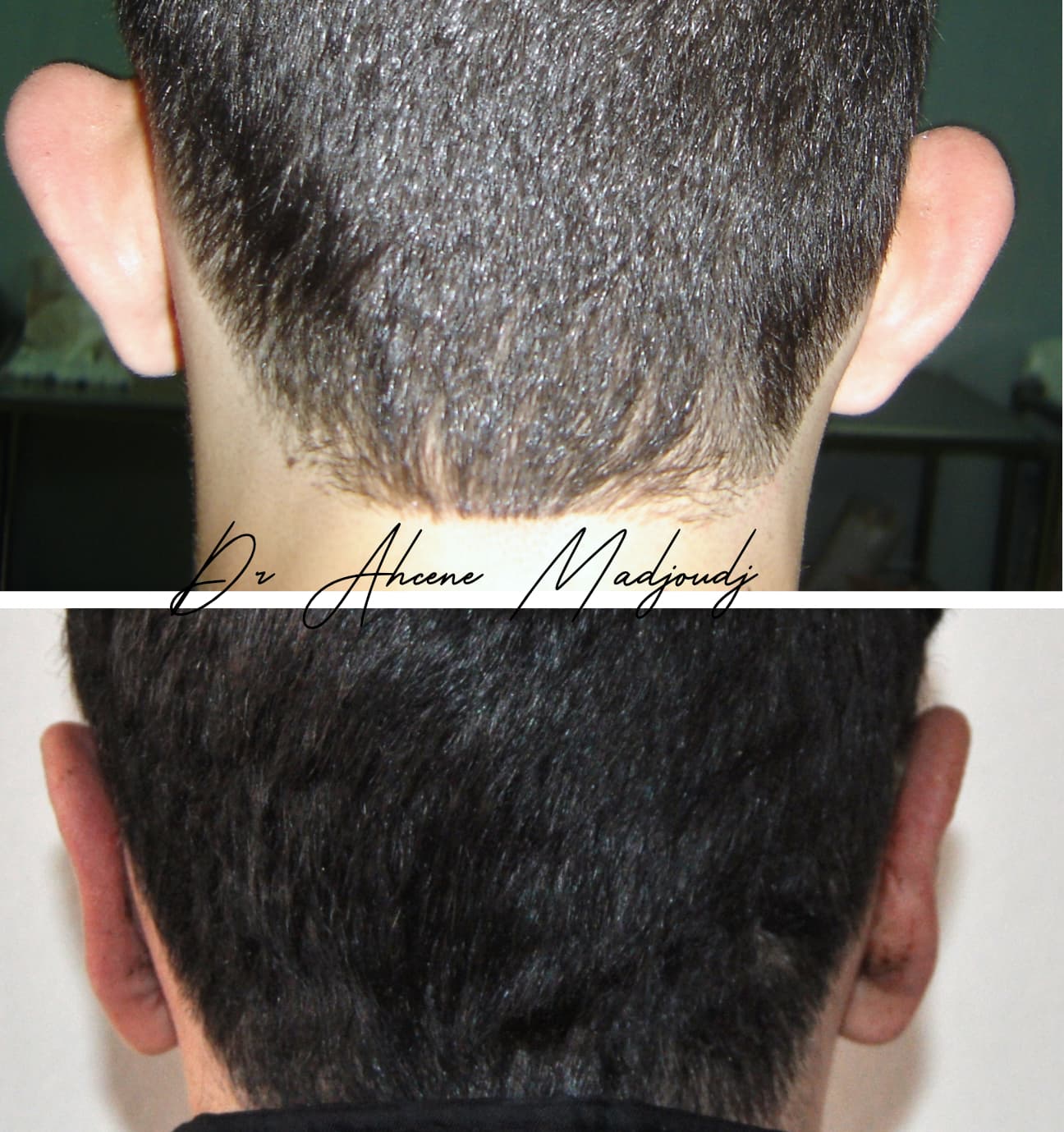 Otoplastie à Alger, Algerie par le Dr Madjoudj 