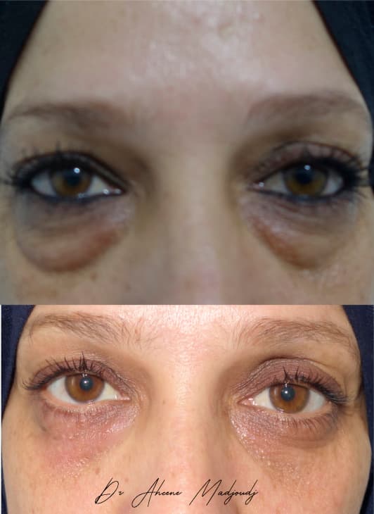 blepharoplastie-femme-2-web.jpg