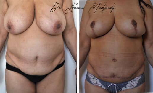 Chirurgie Post-Grossesse ou Mommy Makeover à Algerie
