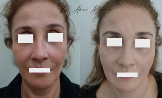 Lipofilling du Visage à Alger, Algerie