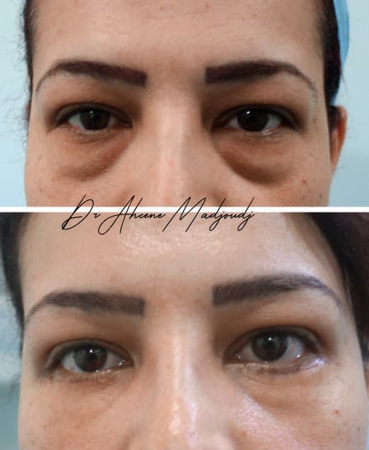 Blépharoplastie à Alger par le Dr Madjoudj |