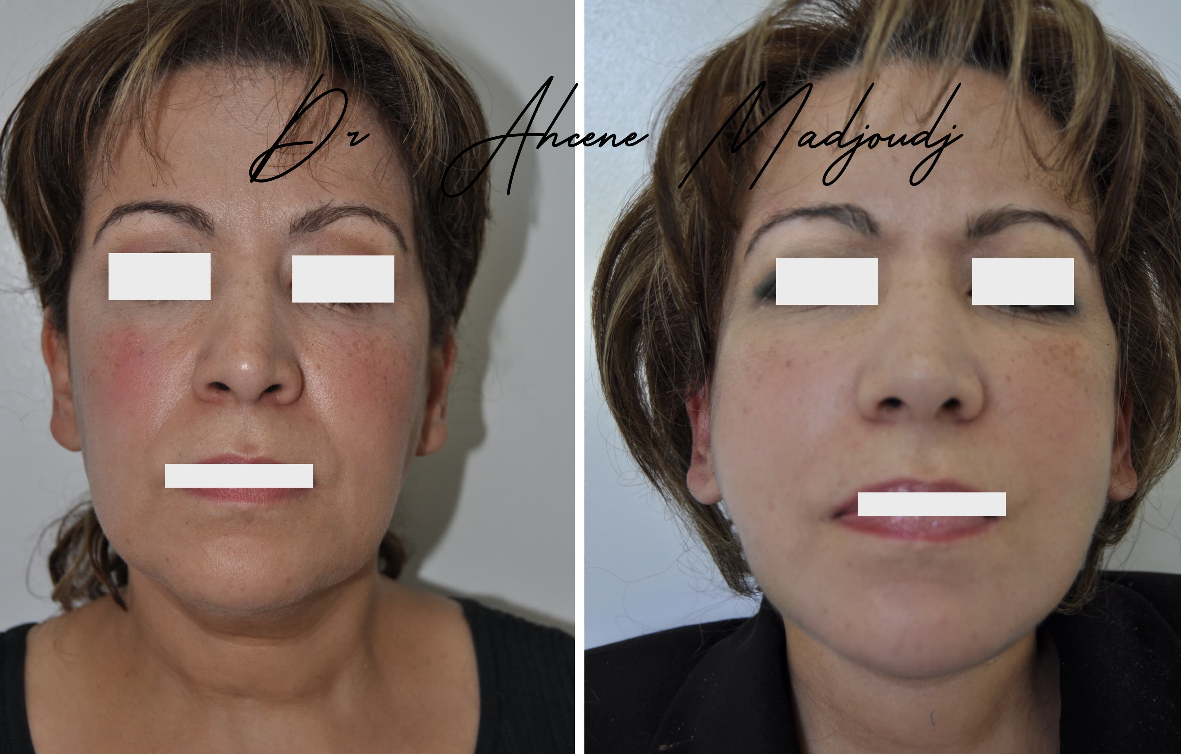 Lifting du Visage en algérie 6 mois aprèss