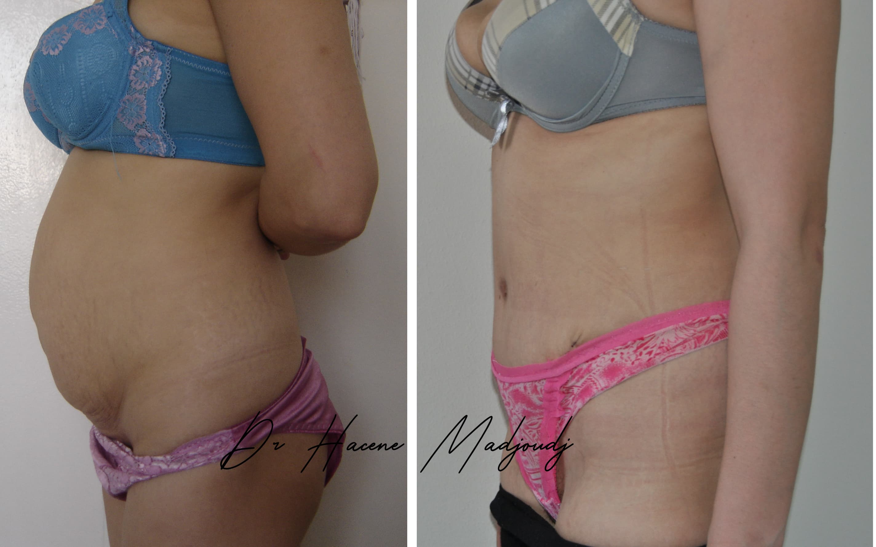 Liposuccion & Liposculpture à Alger,Algerie par Le docteur Madjoudj