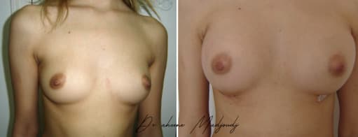Augmentation Mammaire avec Implants à Alger , algerie par le docteur Madjoudj