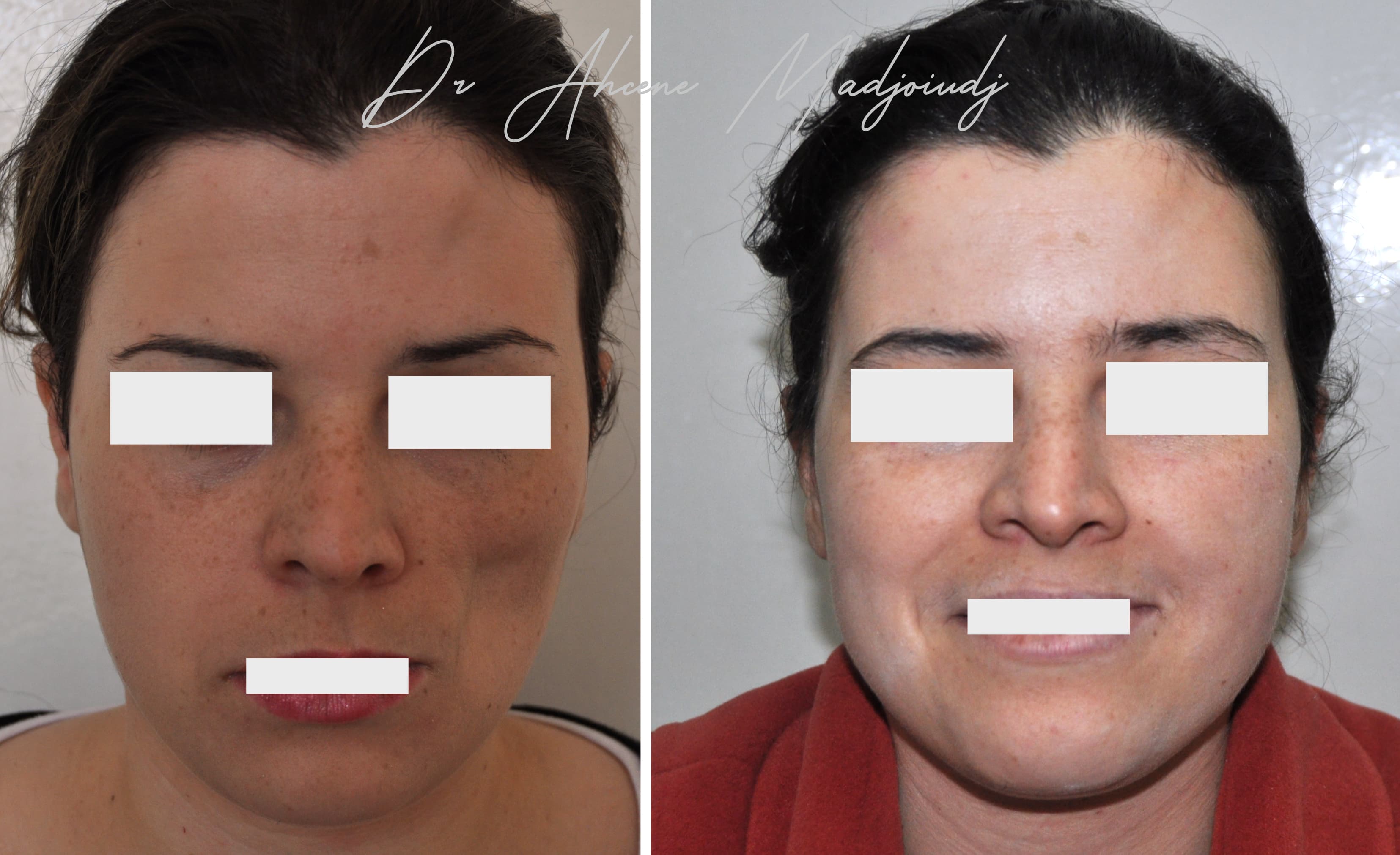 Lipofilling syndrome Parry-Romberg  ]à Alger, Algérie