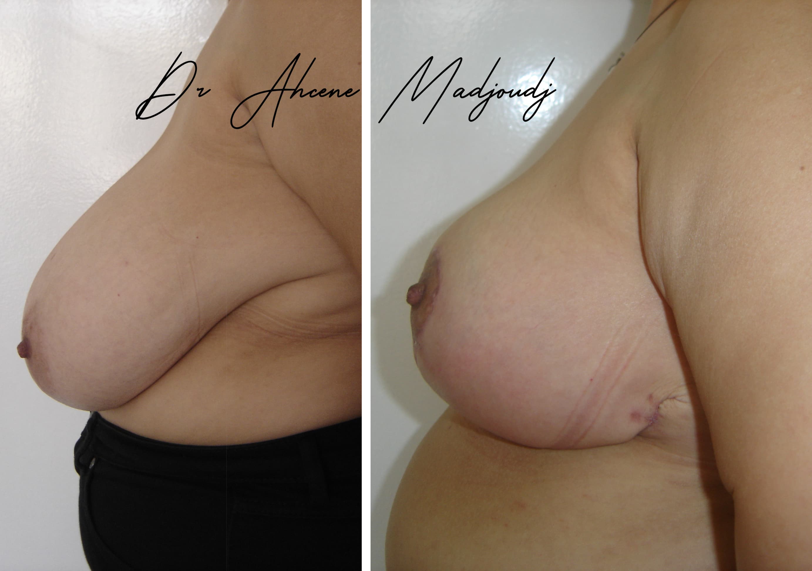 Réduction Mammaire en Algerie par  Le Docteur Madjoudj