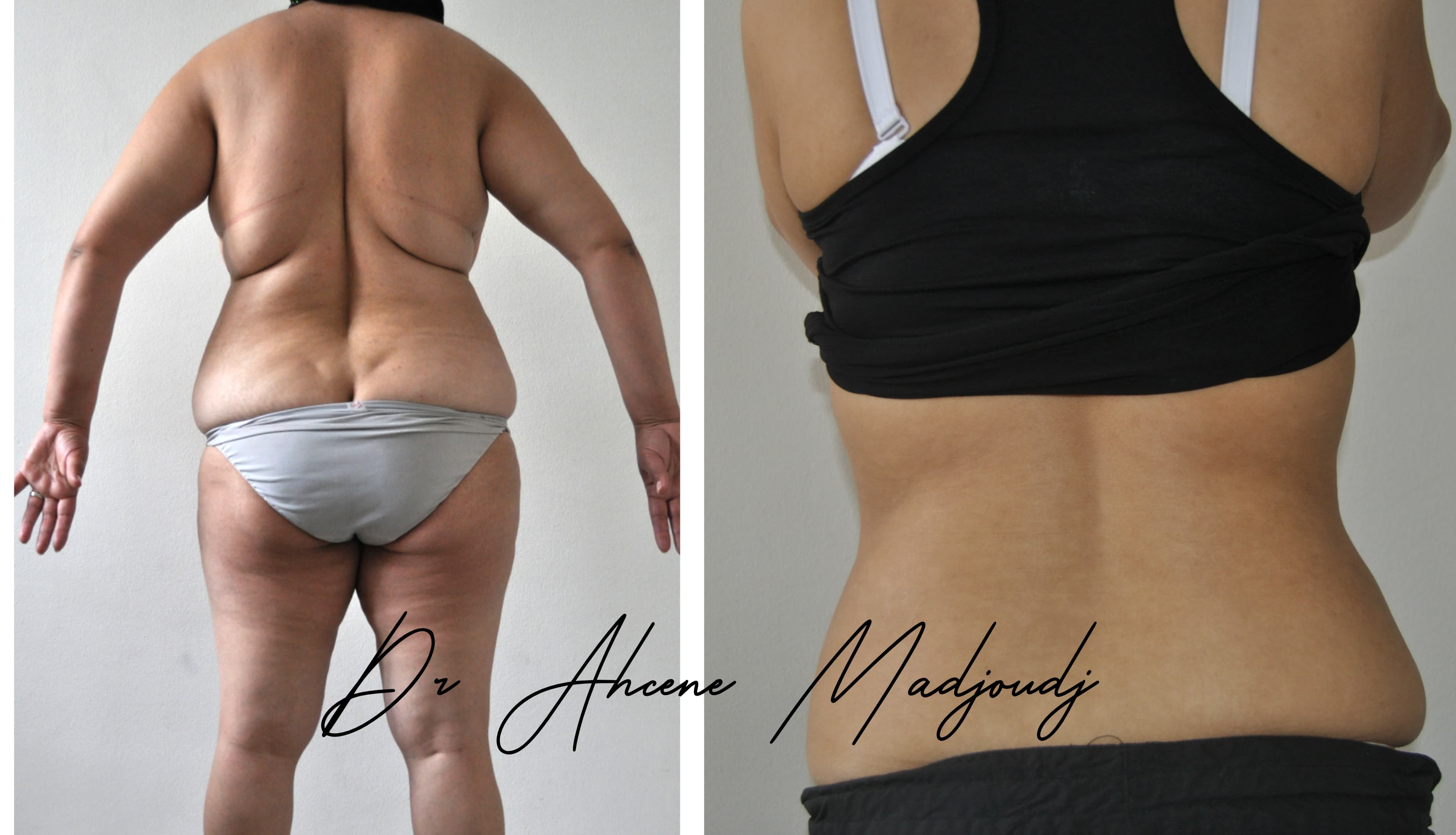 Liposuccion & Liposculpture à Alger par Le docteur Madjoudj