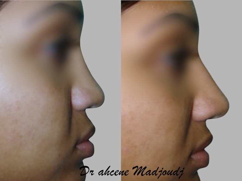 rhinoplastie en algerie par le docteur Madjoudj Ahcene
