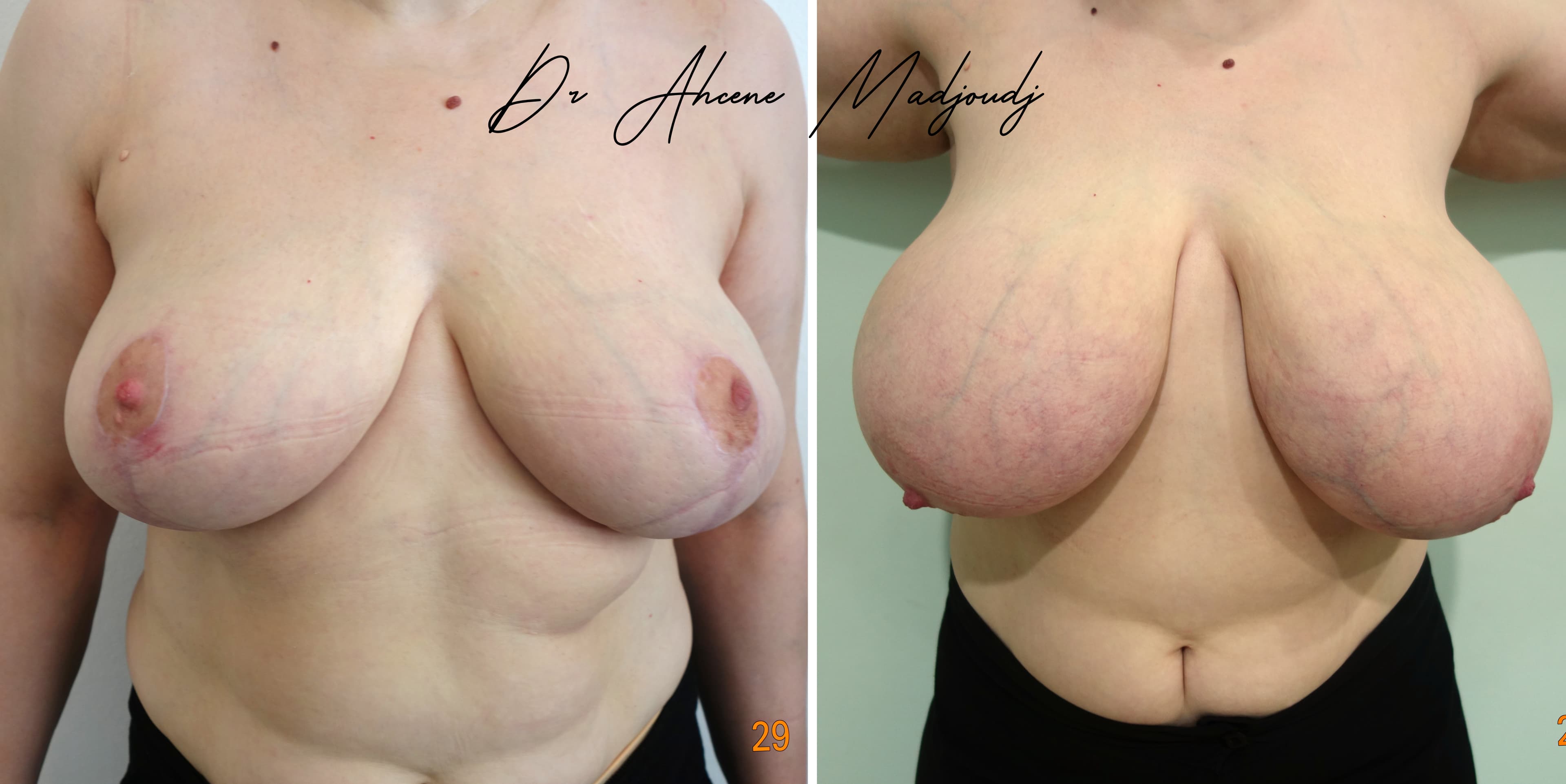Réduction Mammaire à Alger par  Le Docteur Madjoudj