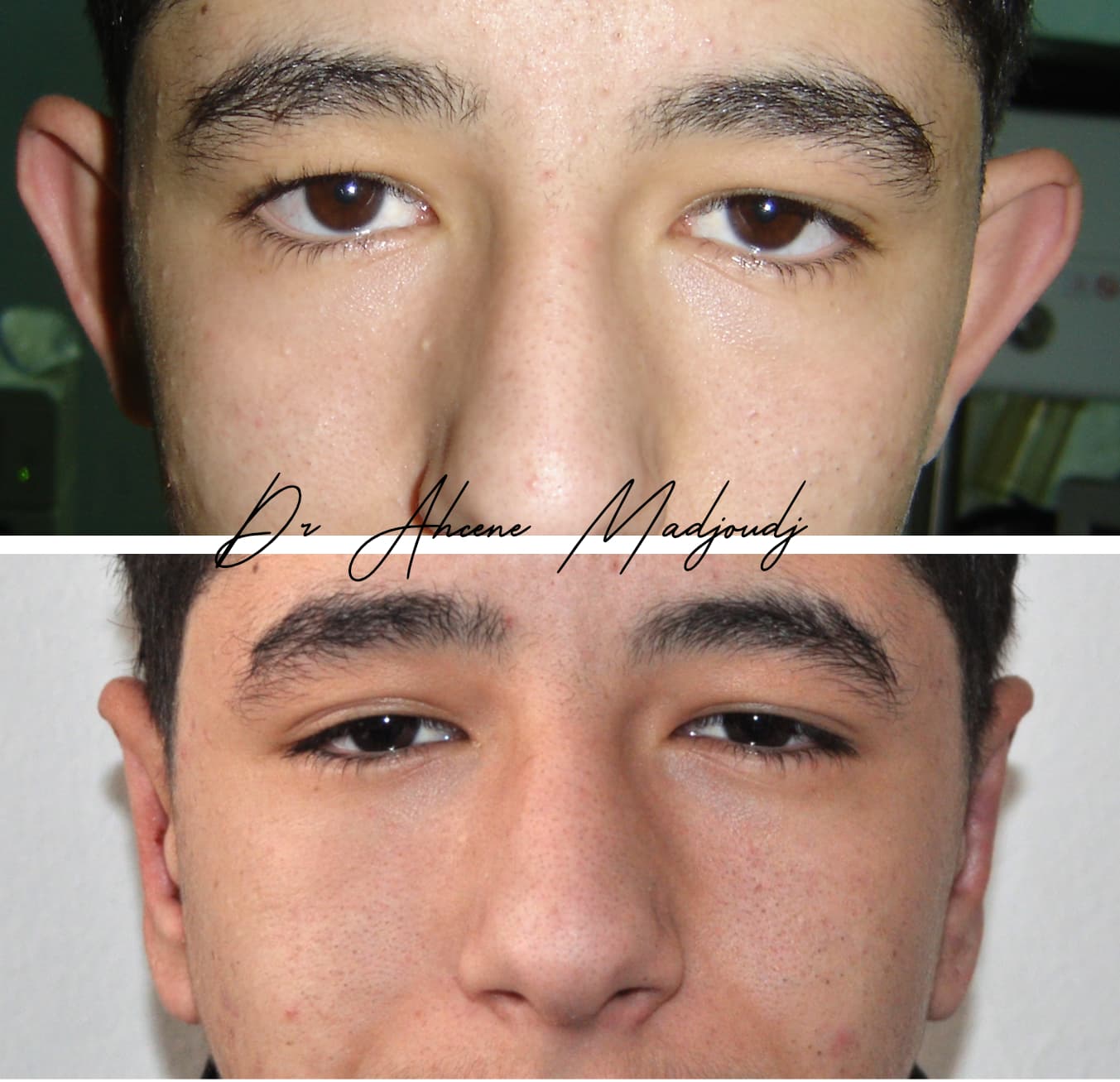 Otoplastie à Alger, Algerie par le Dr Madjoudj 