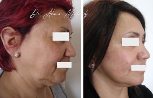 Lifting du Visage en algérie 9 mois après