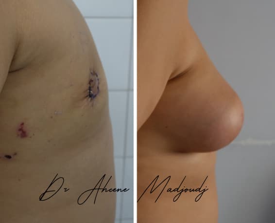 Traitement de la Gynécomastie sévère en Algérie